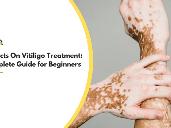 Fast Facts On Vitiligo Treatment: a Complete Guide for Beginners