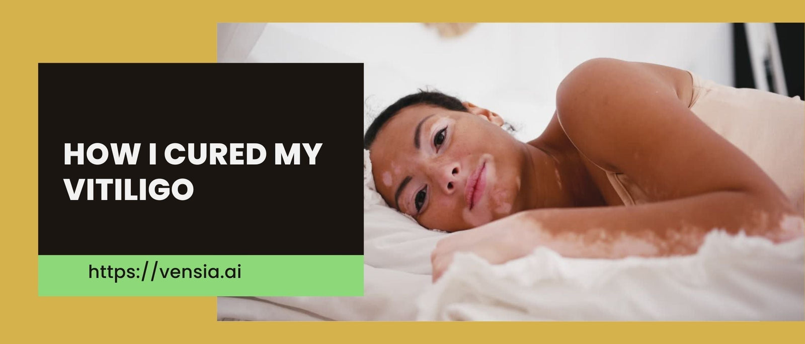 How Should I care My Vitiligo