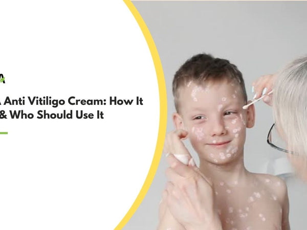 VENSIA Anti Vitiligo Cream How It Works & Who Should Use It