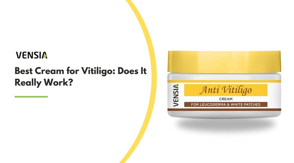 Best Cream for Vitiligo
