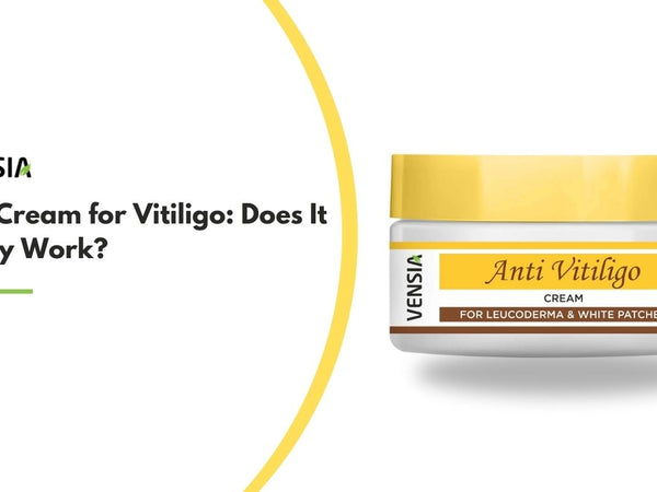 Best Cream for Vitiligo