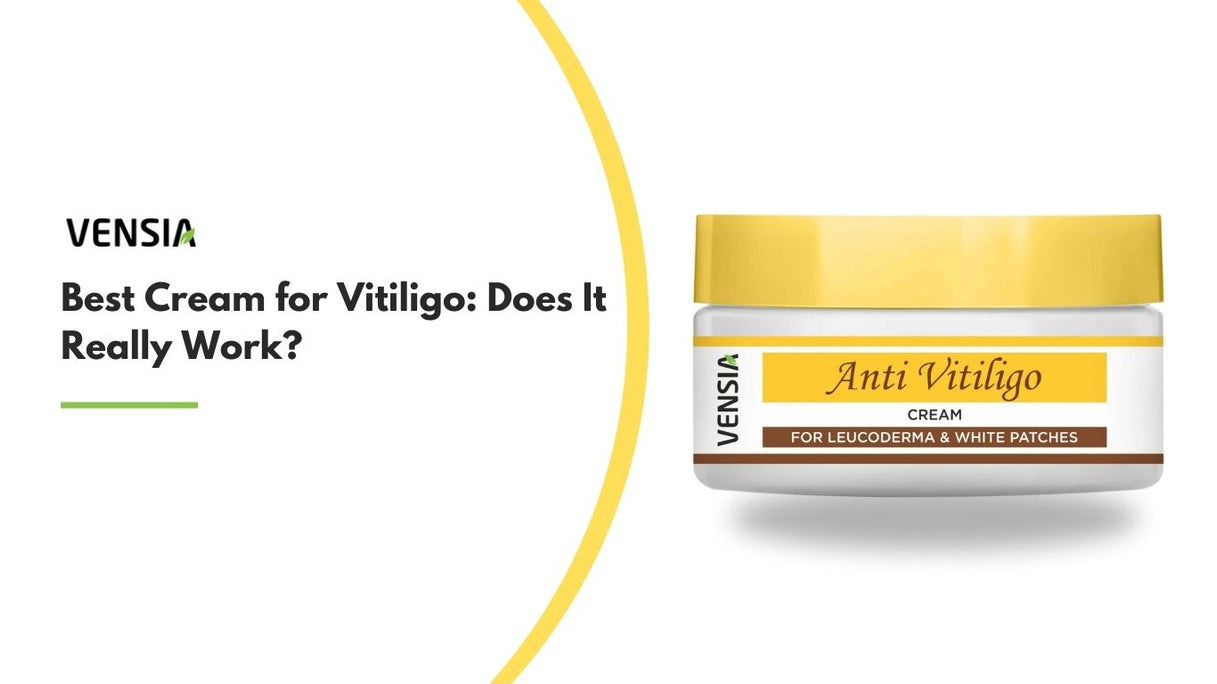 Best Cream for Vitiligo