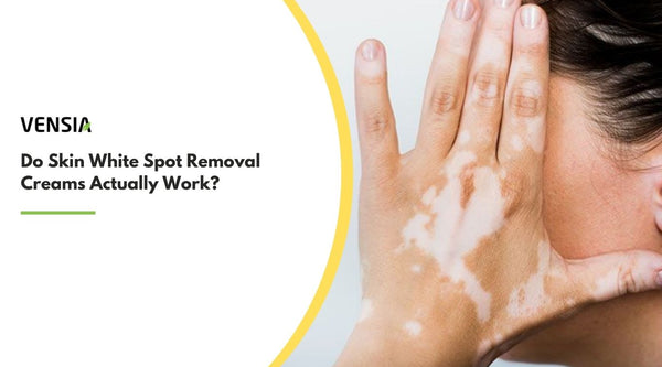 Do Skin White Spot Removal  Creams Actually Work