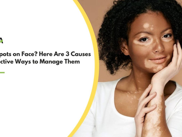 White Spots on Face? Here Are 3 Causes and Effective Ways to Manage Them