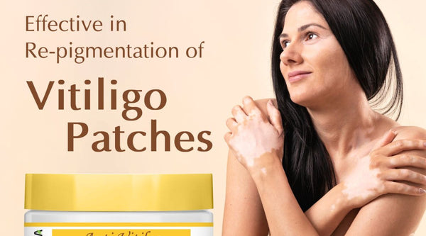 VENSIA Anti Vitiligo Cream: 2026 Repigmentation Guide