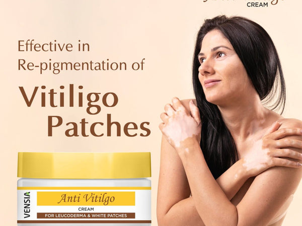 VENSIA Anti Vitiligo Cream: 2026 Repigmentation Guide
