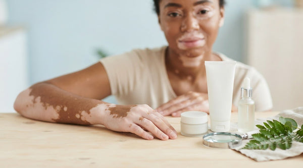 Best Cream for Vitiligo Repigmentation: A Buyer’s Guide