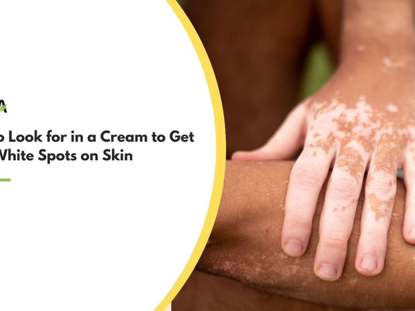 cream to get rid of white spots on skin