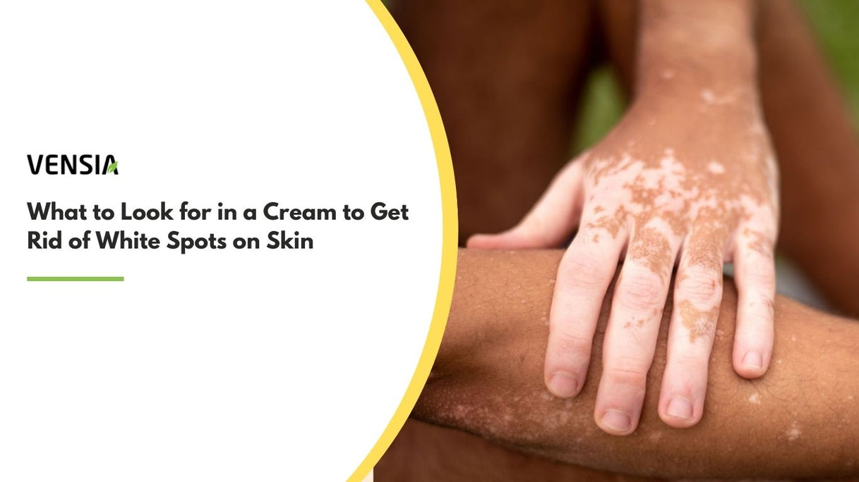 cream to get rid of white spots on skin